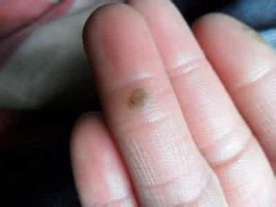 手指僵硬肿胀特效偏方 手指僵硬肿胀特效偏方 治疗“手指僵硬肿胀”的特效验方