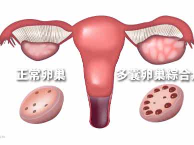 多囊卵巢综合症食疗 多囊卵巢综合症 多囊卵巢综合症食疗