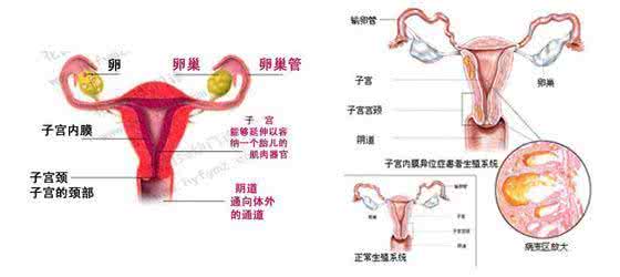 子宫内膜异位症的原因 子宫内膜异位咋造成的 子宫内膜异位症,是什么原因造成的?