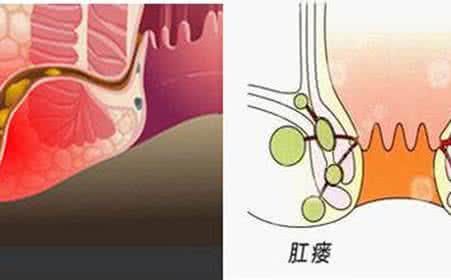 肛瘘有什么偏方治疗 治疗肛瘘的偏方 治疗肛瘘的四种常见方法