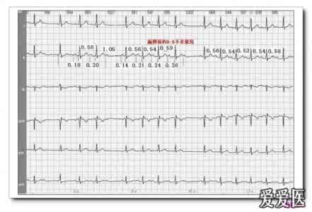 山羊老师心电图讲座 山羊老师课程常见心电图诊断知识讲座第二十一讲—— 心脏传导阻滞1