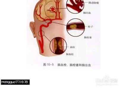 脑出血偏瘫治疗方法 脑出血最佳治疗方法 脑出血如何预防