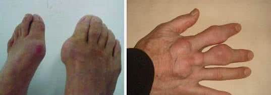 痛风症状的早期表现 痛风的初期症状