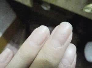 指甲竖纹预示什么疾病 指甲苍白贫血症征兆 手部7信息预示疾病