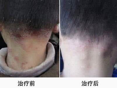 过敏性皮炎怎么引起的 治疗过敏性皮炎 过敏皮炎 过敏引起皮炎应该怎么治疗