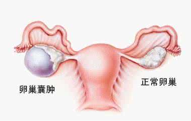 卵巢恶性肿瘤症状 卵巢恶性肿瘤 卵巢恶性肿瘤有哪些症状