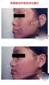 如何防止痤疮 痤疮是什么 如何有效防止痤疮