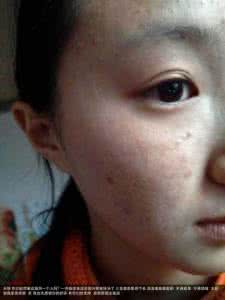 中医看痘痘哪里好 中医看痘痘哪里好 中医看痘痘