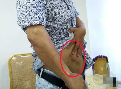 移动两根牙签 男子阑尾手术后 腹腔内惊现两根牙签