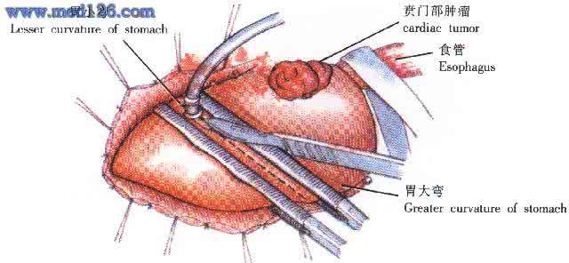 贲门癌中晚期成功案例 贲门癌术后反流性疾病20例诊治体会