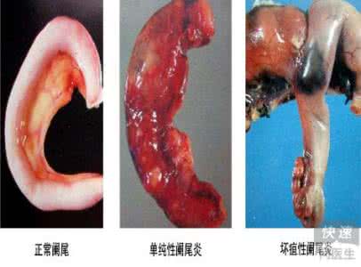 急性阑尾炎的病因 急性盲肠炎 急性阑尾炎的病因