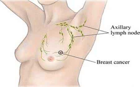 乳头湿疹样乳腺癌 6旬女乳头瘙痒两年 一检查竟是乳腺癌
