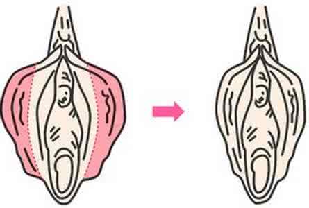 小阴唇长了肉疙瘩图片 阴唇上面长小肉粒是什么原因呢？