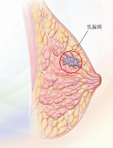 乳腺癌抑制剂 乳腺癌抑制剂 吃沙丁鱼可抑制乳腺癌