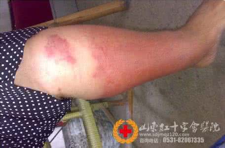 肾气虚的症状 静脉炎的典型症状表现 肾气虚的典型症状有哪些 细数6大症状表现