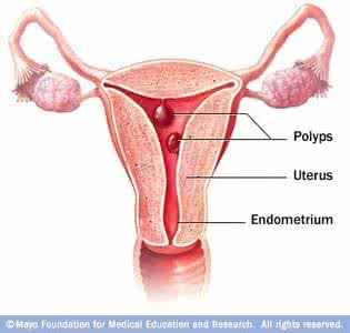 子宫内膜息肉会癌变吗 子宫内膜息肉