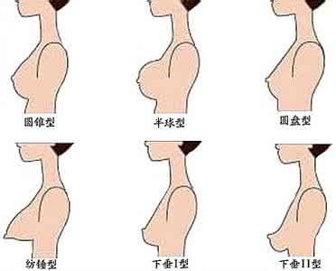 女性乳房下垂 女性乳房下垂 女性乳房下垂类型