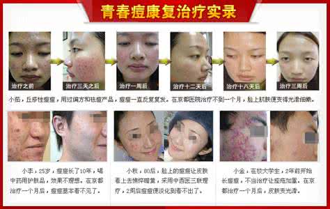 痘痘治疗法 痘痘治疗法 治疗痘痘的手术疗法
