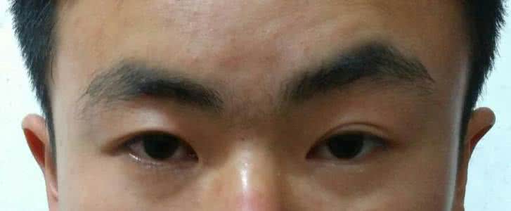 眼睛一上一下不对称 眼睛一上一下不对称 为什么眼睛不对称上拉？