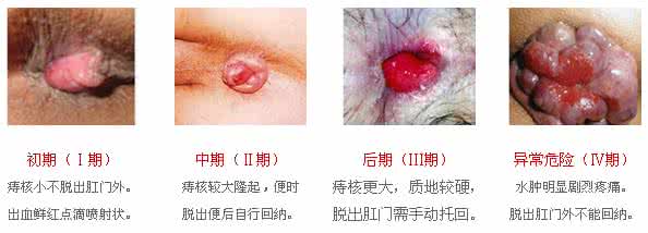 痔疮便血什么症状 痔疮便血什么症状 便血是痔疮的症状吗