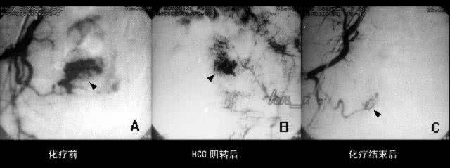 绒癌治愈后能存活多久 绒癌治愈后能存活多久 绒癌能治愈吗?