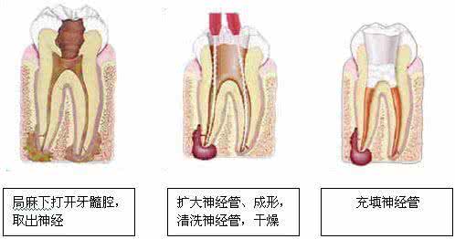 牙髓炎症状怎么治疗 牙髓炎的治疗 了解牙髓炎的症状