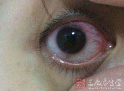 避暑消夏 泳池里避暑消夏一不留神患了“红眼病”