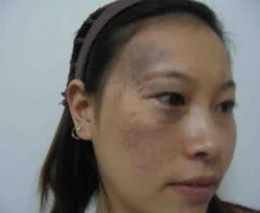 有太田痣怎么办 患有太田痣怎么办？