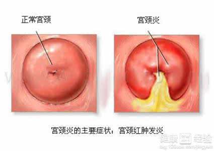 产后宫颈炎的症状 产后宫颈炎症状有哪些 宫颈炎后会出现哪些症状