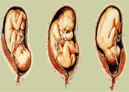 胎盘后壁的优点 胎盘后壁是不是不显怀