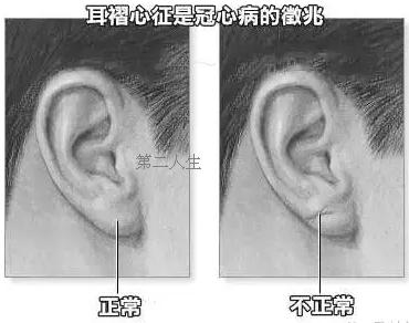 耳垂上有折痕 耳垂有折痕看健康