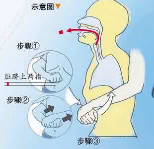 吞食异物的急救处理 误吞异物时的急救处理