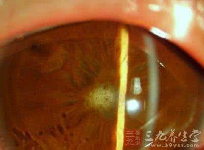 治疗脚气的中药方剂 五官科方剂 治疗虹膜睫状体炎的中药方剂