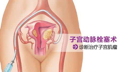 肿瘤的生物治疗方法 子宫肌瘤的治疗方法 女人这里长一物竟是肿瘤