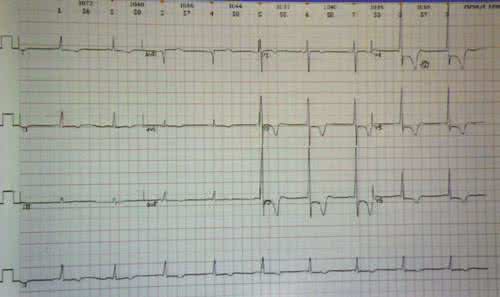 心肌缺血心电图 临床必备：2小时学看心肌缺血心电图（三）