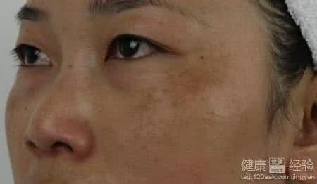 黄褐斑是怎么引起的 黄褐斑图片 黄褐斑是怎么引起的
