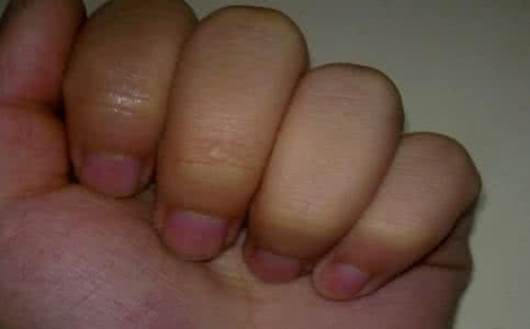 怀孕几个月开始水肿 怀孕几个月水肿 怀孕几个月就会出现腿肿
