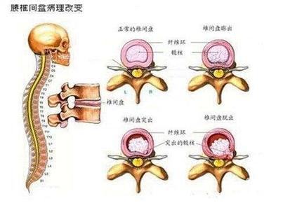腰间盘突出小方子 腰间盘突出小方子，七天见效！