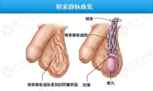 治疗静脉曲张的偏方 图解:静脉曲张的危险因素及治疗