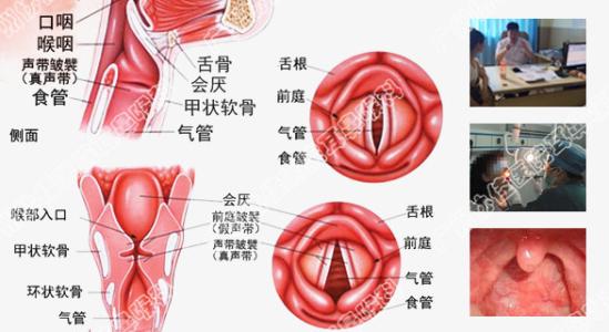 如何防治咽喉炎 咽喉炎如何治疗 治疗咽喉炎 如何正确防治咽喉炎