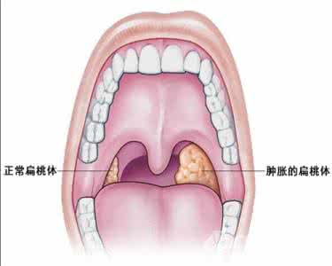 扁桃体发炎怎么好得快 扁桃体发炎如何能好得快