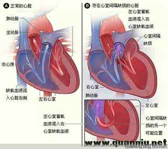 冠心病和心脏病的区别 振心阳才能救心脏！此方治冠心病，四招盘活垂死心脏