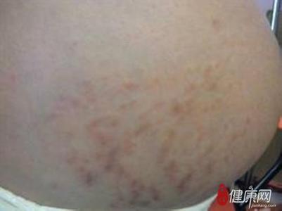 治疗痒疹的快速偏方 妊娠痒疹的病因
