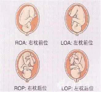 loa胎位应往哪边睡觉 胎位loa是什么意思