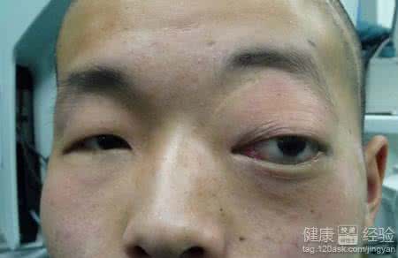 眼眶部粒细胞肉瘤 眼眶部粒细胞肉瘤 眼眶脂肪肉瘤有什么预防护理方法