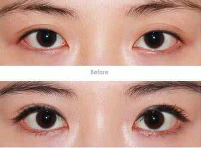 开眼角副作用 开眼角副作用 内眼角开大术的作用是什么?
