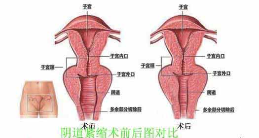 一日一结 缩紧结 阴道缩紧 能用多久 阴道缩紧的优缺点分析