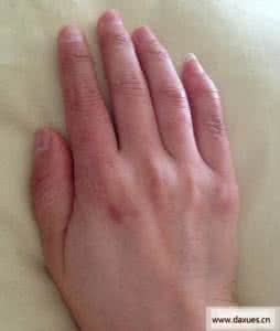 治疗冻疮最有效的偏方 治疗冻疮的偏方 十大偏方治冻疮