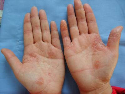 什么是掌跖脓疱病 掌跖脓疱病怎么治 掌跖脓疱病的病因有哪些