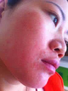 吃药皮肤过敏怎么办 吃药皮肤过敏怎么办 皮肤过敏要注意什么